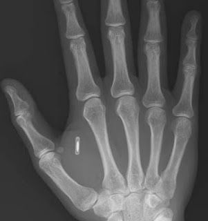 Swedish woman gets microchip 'key' implanted in hand