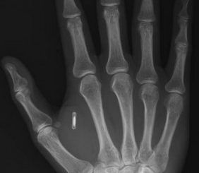 Staff at Swedish office to be implanted with RFID chips
