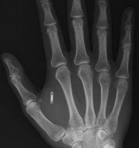 Staff at Swedish office to be implanted with RFID chips
