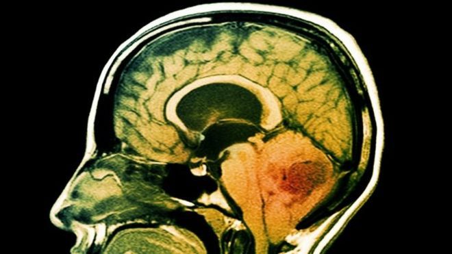 Scientists have discovered that antidepressants and blood thinners can cause brain cancer to eat itself