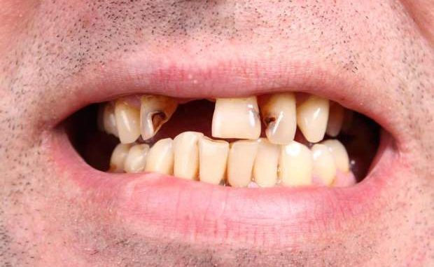 A new study proves that fluoride does not create healthy teeth as Brits are said to have better teeth than Americans