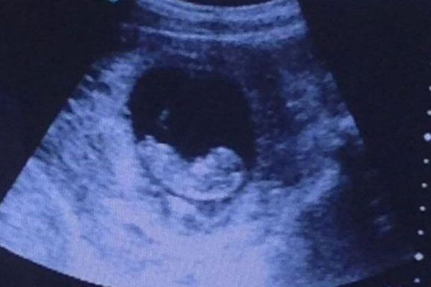 Weird creature seen in ultrasound images