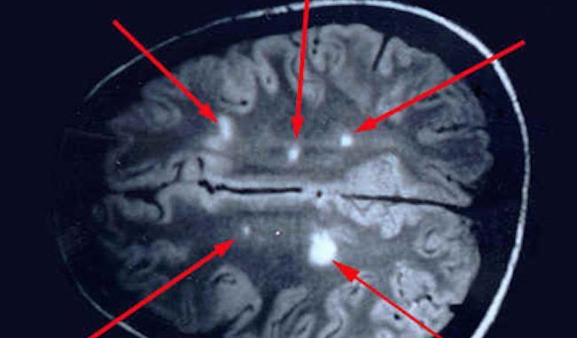 Why multiple sclerosis is lyme disease