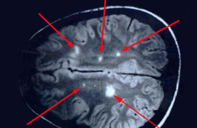 Why multiple sclerosis is lyme disease
