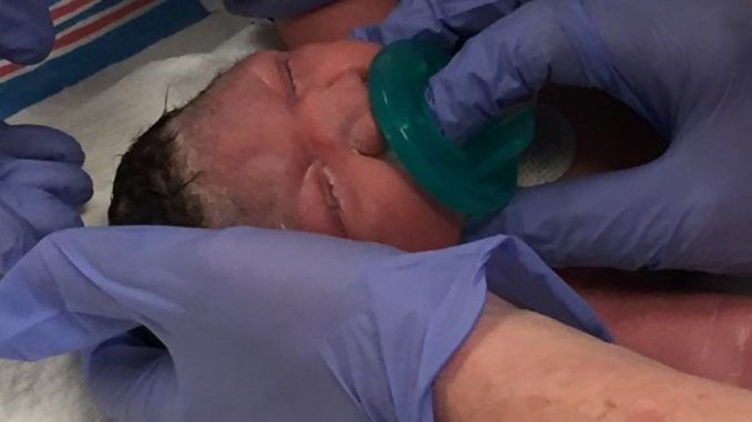 Mom in New Jersey gives birth to Microcephaly baby