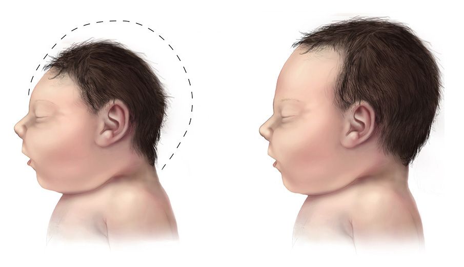 The birth defect most frequently associated with Zika is microcephaly, an incurable condition that causes brain damage and small head size.