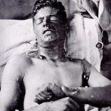 Soldier after involuntary exposure to mustard gas via gas chamber.