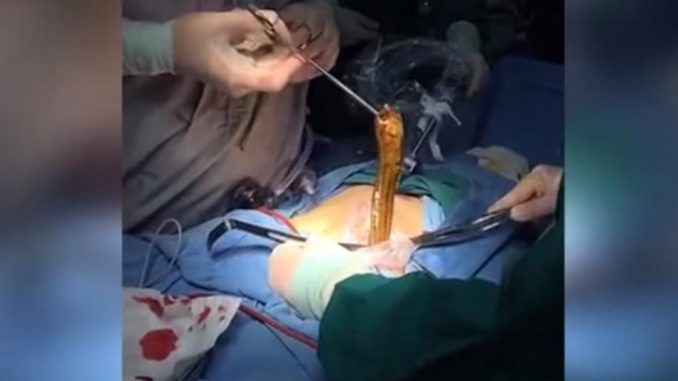 Doctors remove giant eel from drunk man's butt
