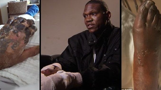 A Dallas "health fanatic" who was told he was in "top shape" when he received the flu shot, is now set to lose all his fingers and toes.
