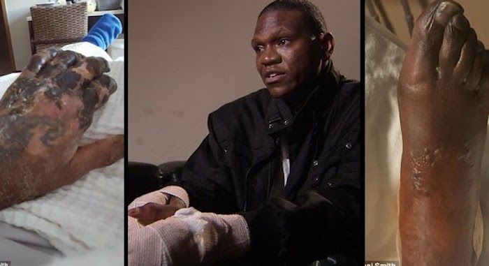 A Dallas "health fanatic" who was told he was in "top shape" when he received the flu shot, is now set to lose all his fingers and toes.