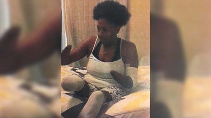 A Charlotte mother was left without hands and feet after a botched surgery, after initially needing only "routine" Fallopian tube surgery.