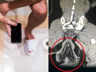 A man who had been sitting on the toilet playing games for hours was hospitalized after noticing a ball-sized lump dangling from his anus.