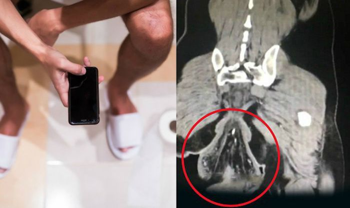 A man who had been sitting on the toilet playing games for hours was hospitalized after noticing a ball-sized lump dangling from his anus.