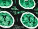 Adderall causes brain damage, study warns