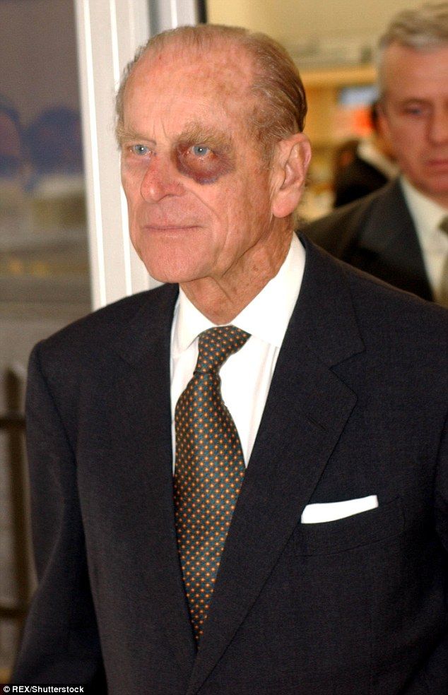 Royals have also been photographed with black eyes in the past, including Prince Philip. He is pictured here in 2004 