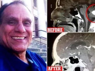 Doctors in California are mystified after finding a patient’s suspected malignant brain tumor disappeared without surgical intervention.