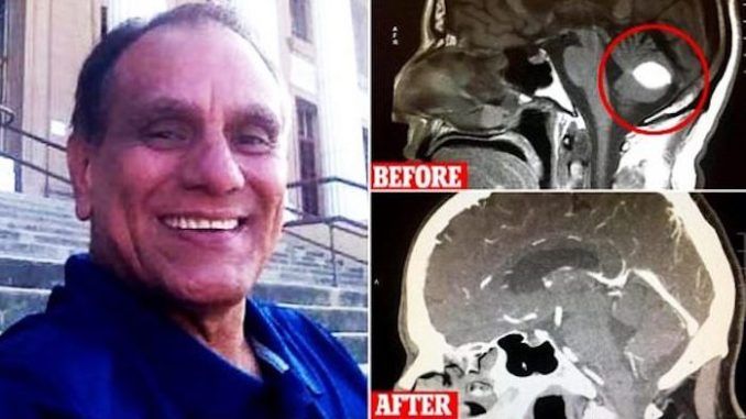 Doctors in California are mystified after finding a patient’s suspected malignant brain tumor disappeared without surgical intervention.