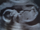 Two US States ban abortion after heartbeat is detected