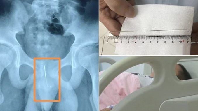 A 12-year-old Chinese was transported to hospital for emergency surgery after inserting a 4-inch acupuncture needle into his penis.