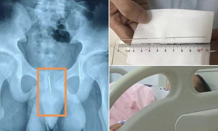 A 12-year-old Chinese was transported to hospital for emergency surgery after inserting a 4-inch acupuncture needle into his penis.