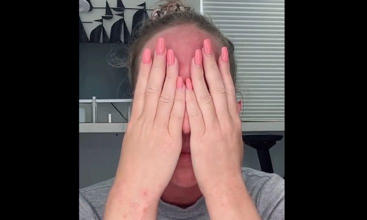Woman sobs are vaccine injury results in her face melting off