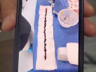 10 inch blood clot removed from vaccinated person - video