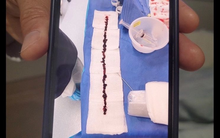 10 inch blood clot removed from vaccinated person - video