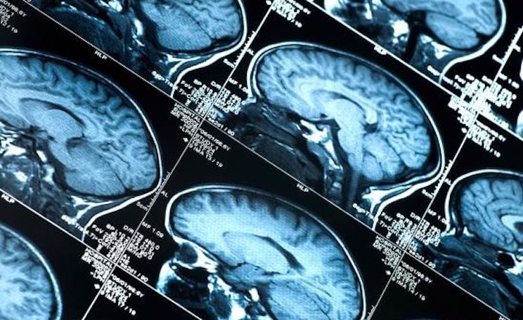 EU study concludes COVID jabs cause brain damage