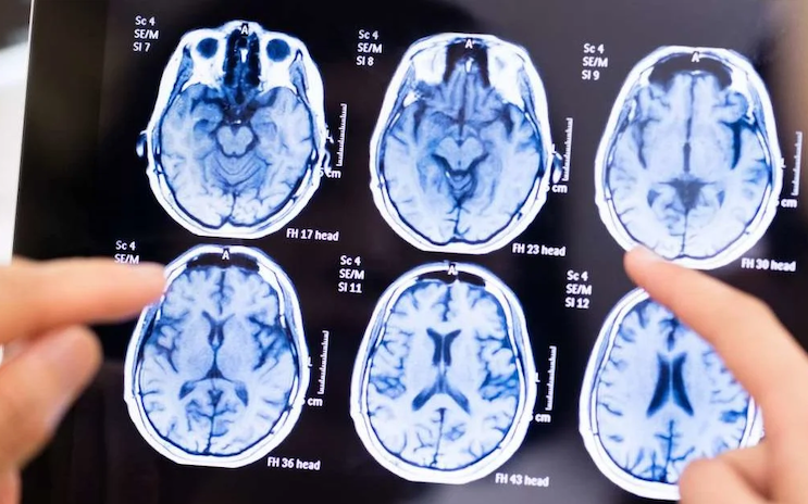 Scientists say Alzheimer’s is caused by brain fungal infection