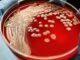 Super gonorrhea to be next pandemic out of China, CDC warns.