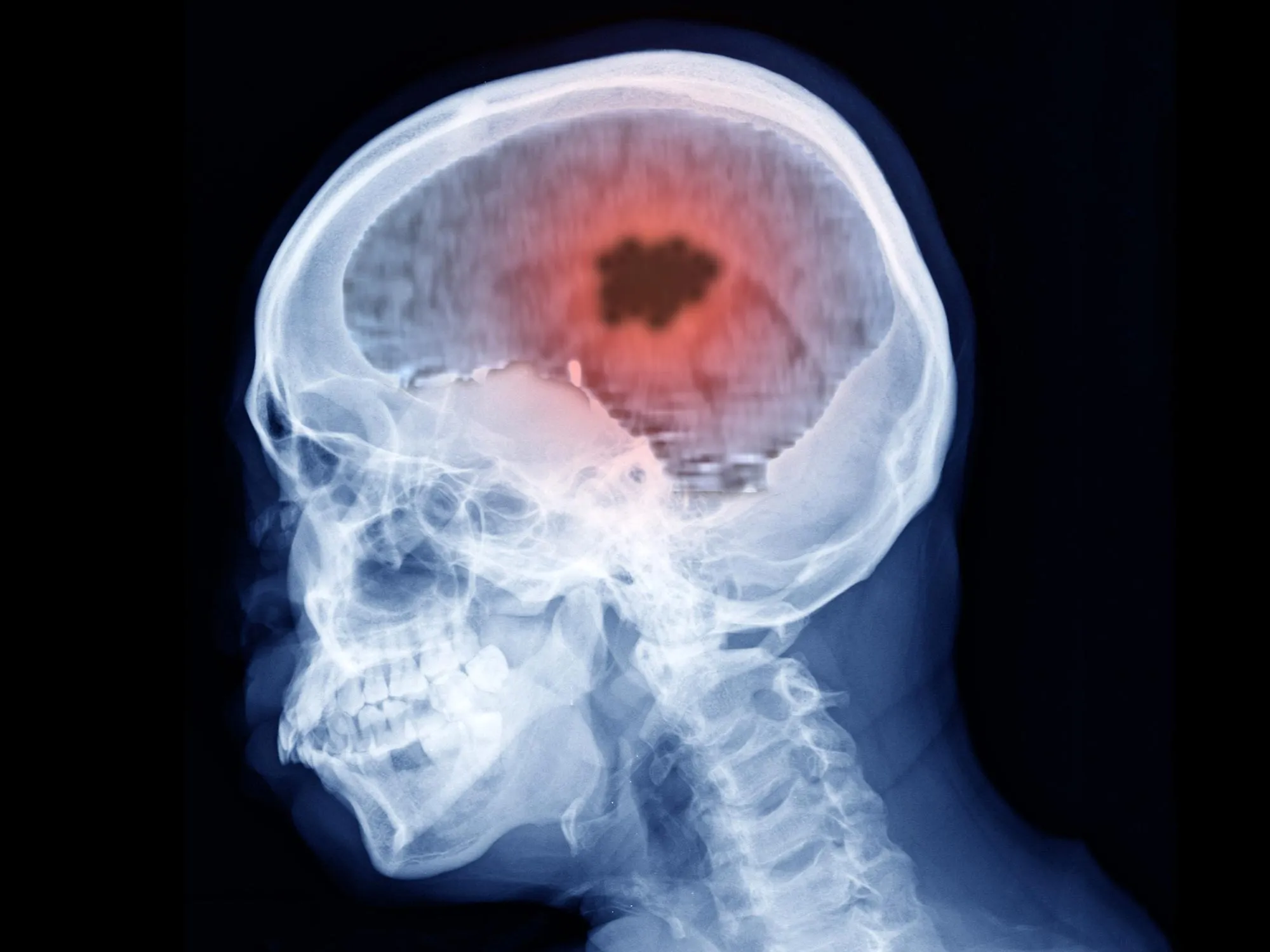 CDC Study Reveals Covid Vaccines Linked to 111,795% Increase in Brain Clots
